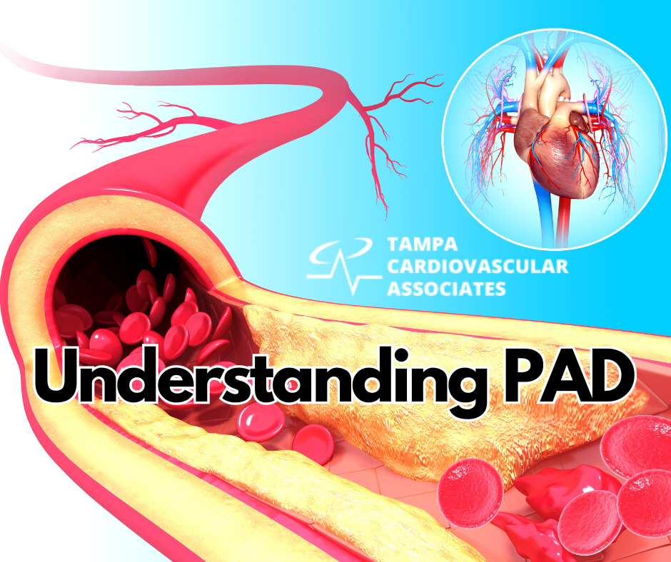 Understanding PAD West florida Vascular and VEin