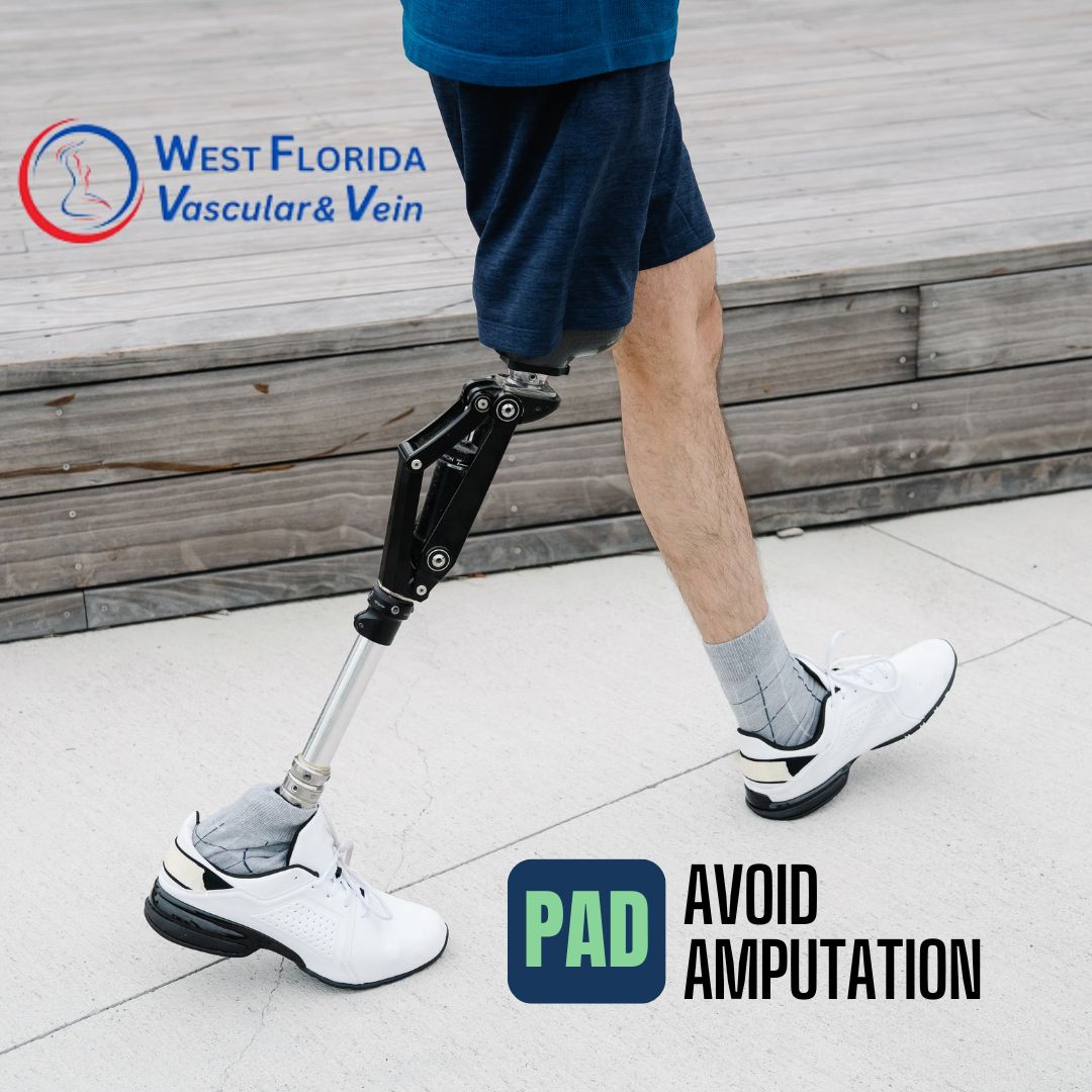 West florida vascular and vein Avoid Amputation due to PAD in Tampa and Safety Harbor