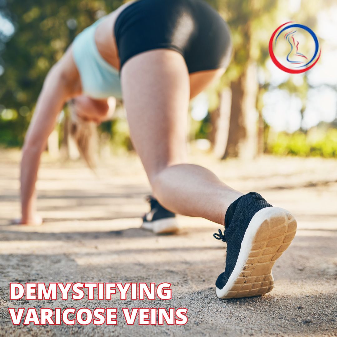 Demystifying varicose veins