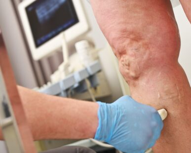 Breakthroughs in Treating Spider Veins and Boosting Confidence: What You Need to Know Now