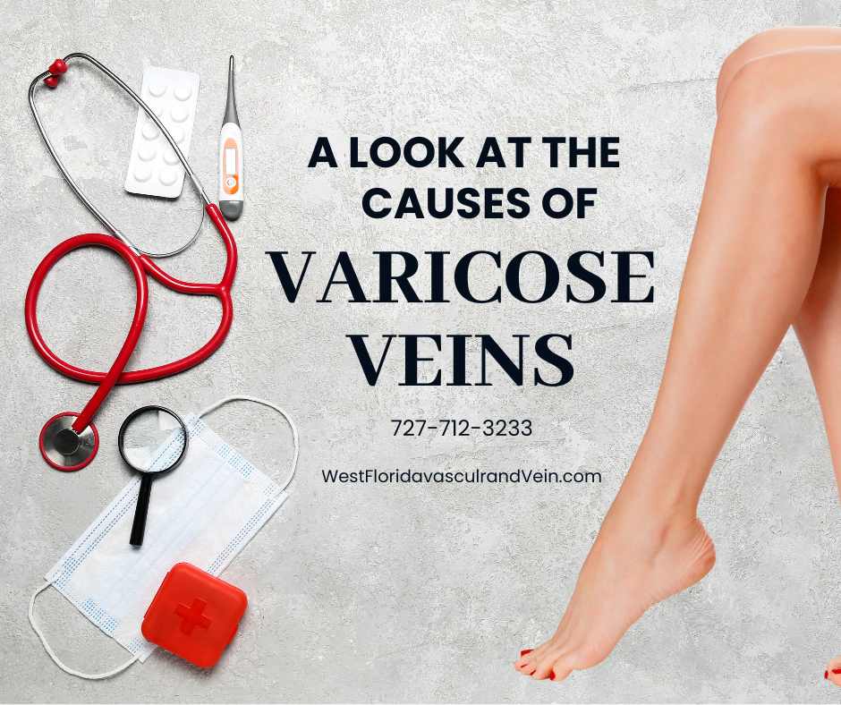 A look at the causes of Varicose Veins West florida vascular and vein treatment
