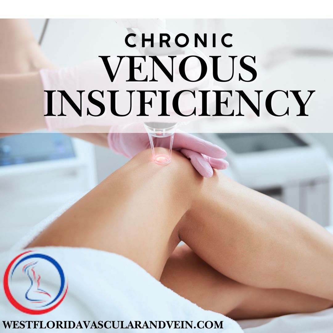 West Florida Vascular and Vein is your source for all Vein issues vein insufficiency, dvt, varicose and spider veins.