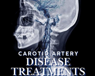 Carotid artery disease treatments West florida vascular and vein
