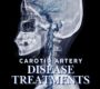 Carotid artery disease treatments West florida vascular and vein 90x80