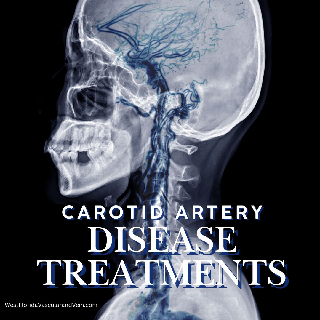 Carotid artery disease treatments West florida vascular and vein