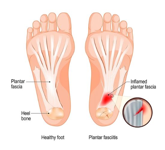 Tampa Plantar Fasciitis Doctor | Tampa Plantar Fasciitis Treatment Procedure Center